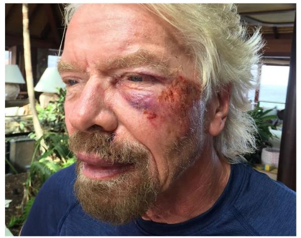 Branson has had several cycling accidents that have left him bruised and bloodied.